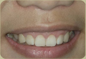 【治療後】牙齦變的又白又漂亮牙齦的厚度也很適中